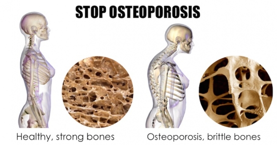 Osteoporosis La enfermedad silenciosa