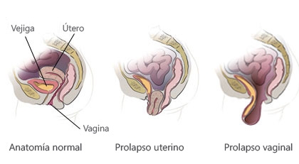 Prolapso Vaginal