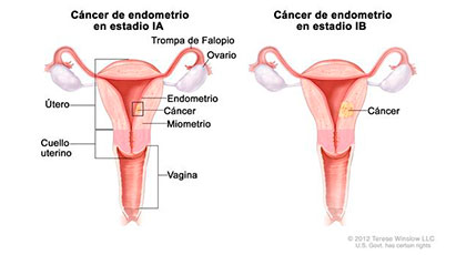càncer endometri