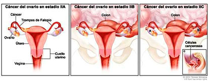 cancer epitelal ovario