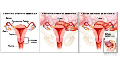 Càncer epitelial d'ovari