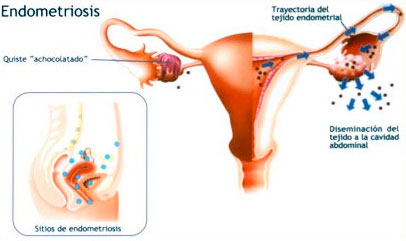 endometrosis esquema
