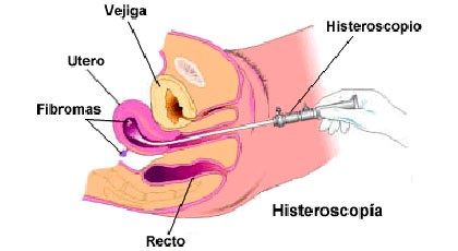 histeroscopia diagnostica