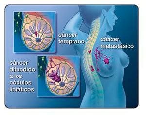patologia mamaria esquema