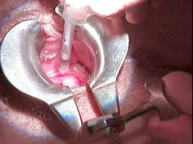 Inyección de radiotrazador a nivel cervical