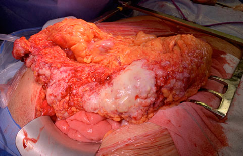 Estadios avanzados de cáncer de ovario