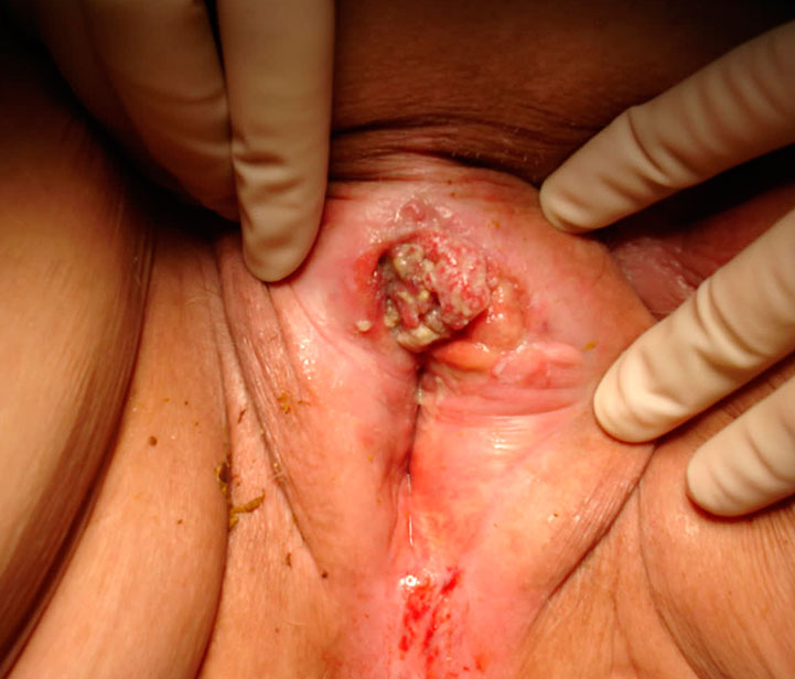 cancer de vulva