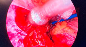 centinela laparoscopia linfadenectomia iliacos