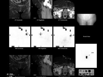Linfogammagrafía para la detección del ganglio centinela con radiotrazador