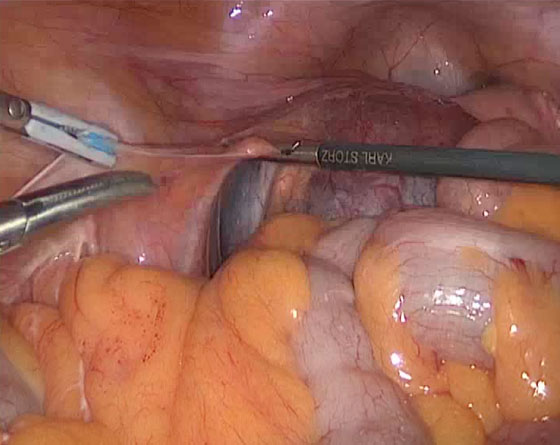 Visión intrabdominal laparoscópica 