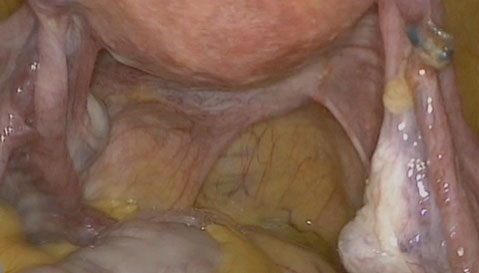 Visión laparoscópica de genitales 