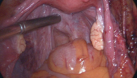 Visión laparoscópica de genitales 
