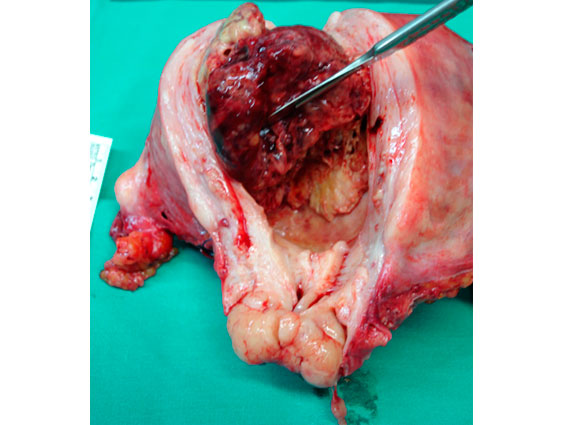 Utero: visión de la neoplasia endometrial.