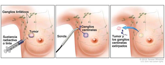detección ganglio centinela en cáncer de mama 