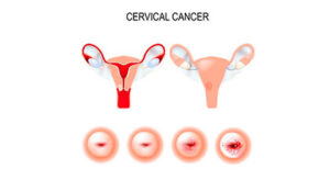 cancer de cervix