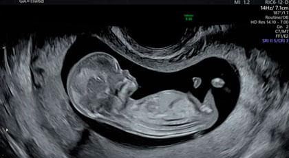 diagnòstic prenatal no invasiu