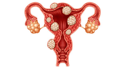 miomes uterins