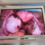 endometrioma per laparoscopia