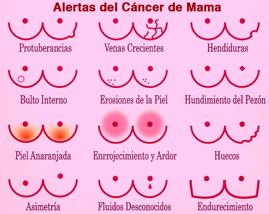 imagen de los signos de alarmas del cáncer de mama.
