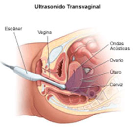 ecografía ginecológica transvaginal