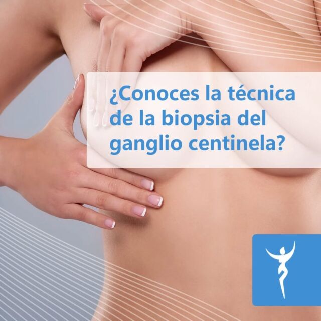 La biopsia del ganglio centinela es una técnica quirúrgica mínimamente invasiva para determinar si un tumor se ha diseminado al sistema linfático. Se utiliza en cánceres como el de mama, endometrio y melanoma. Se extirpa el primer ganglio linfático al que drena el tumor, se analiza y se decide el tratamiento más adecuado. Si el resultado es negativo, se evita la extracción de más ganglios, reduciendo riesgos como el linfedema. Es un procedimiento seguro incluso en pacientes con prótesis mamarias o embarazadas, así como disminuye complicaciones postoperatorias. Puedes consultarnos, somos expertos en esta avanzada técnica. (Link en la Bio)

#ishtarginecologia #ginecologia #prevencion #expertos #diagnostico #tratamientos #saludfemenina #ganglio #centinela